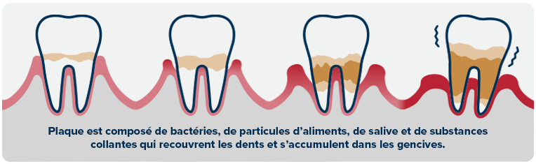 Plaque, est composé de bactéries, de particules d’aliments, de salive et de substances collantes qui recouvrent les dents et s’accumulent dans les gencives.