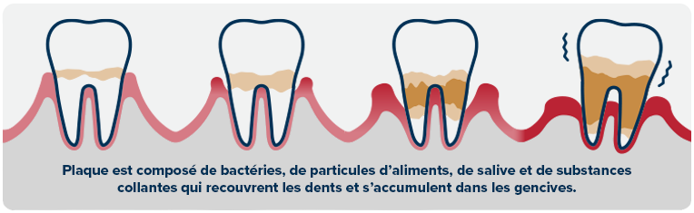 ps-dental-infographic-2-FR.png Plaque, est composé de bactéries, de particules d’aliments, de salive et de substances collantes qui recouvrent les dents et s’accumulent dans les gencives.